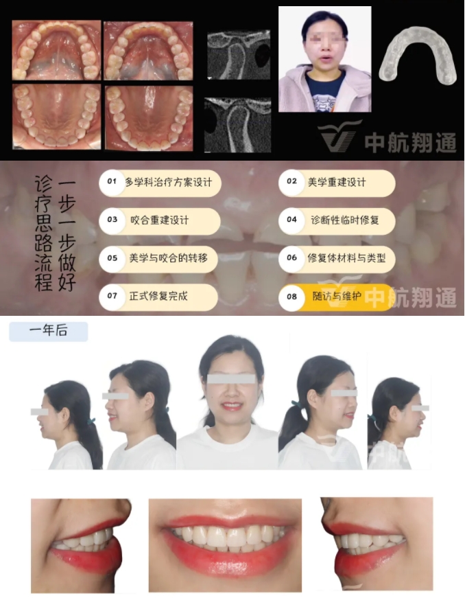 2024华人美学临床病例大赛获奖病例|数字化辅助牙列重度磨耗的美学和功能重建一例