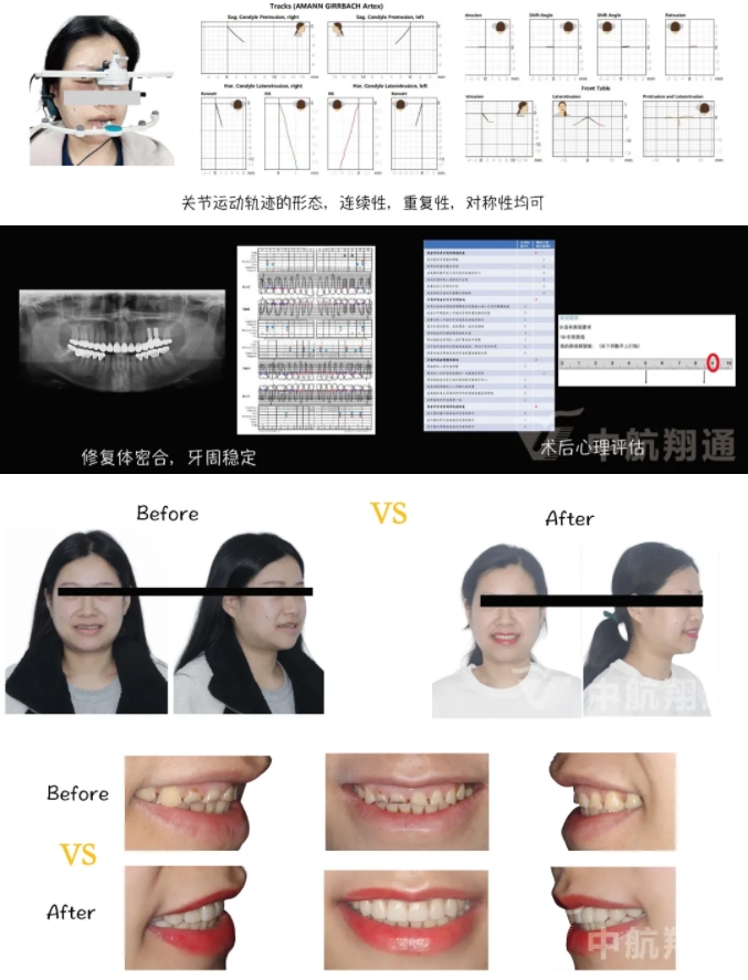 2024华人美学临床病例大赛获奖病例|数字化辅助牙列重度磨耗的美学和功能重建一例