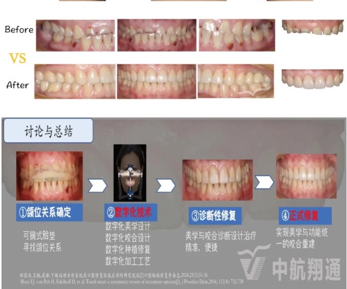 2024华人美学临床病例大赛获奖病例|数字化辅助牙列重度磨耗的美学和功能重建一例