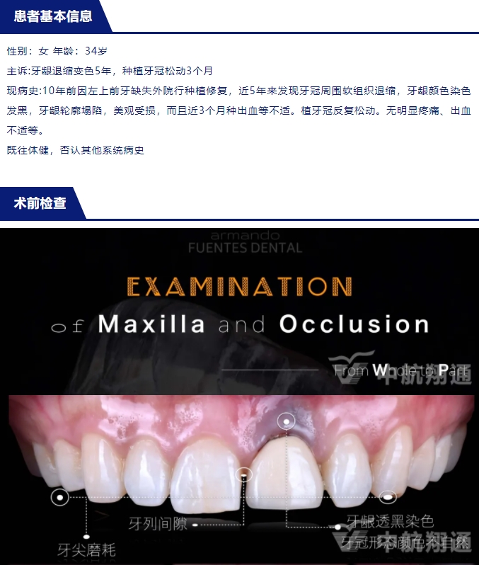 PSTD软组织增量之后的美学修复