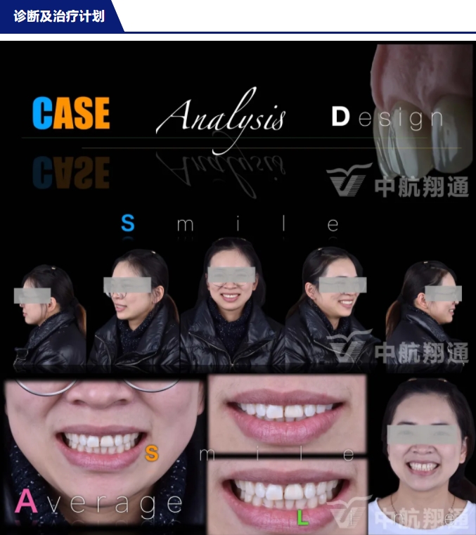 PSTD软组织增量之后的美学修复