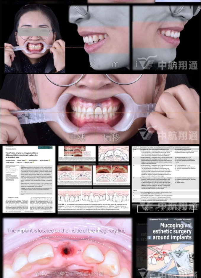 PSTD软组织增量之后的美学修复