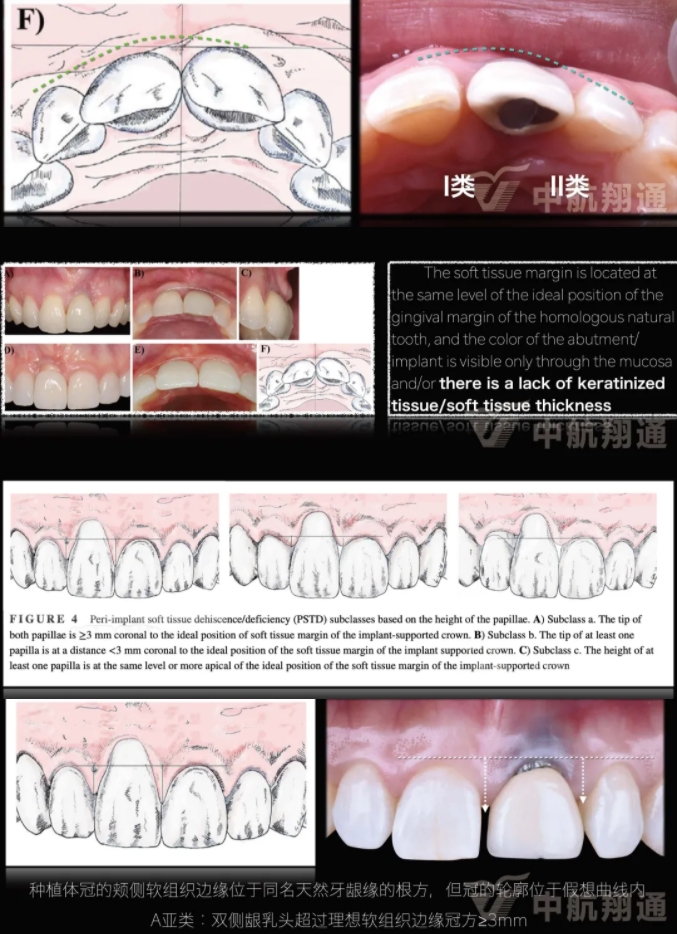PSTD软组织增量之后的美学修复