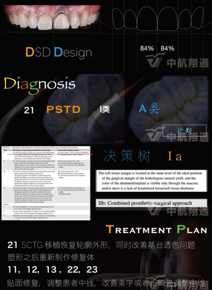 PSTD软组织增量之后的美学修复