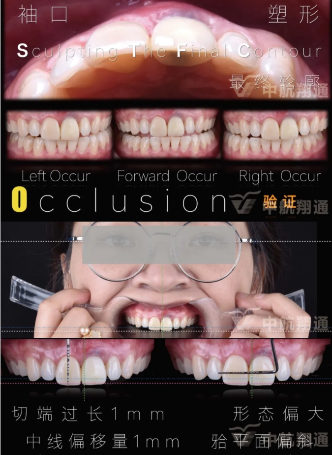 PSTD软组织增量之后的美学修复