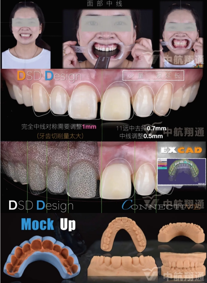 PSTD软组织增量之后的美学修复