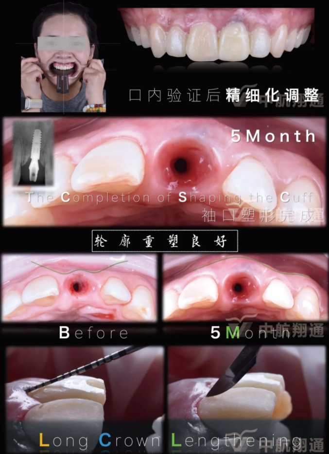 PSTD软组织增量之后的美学修复