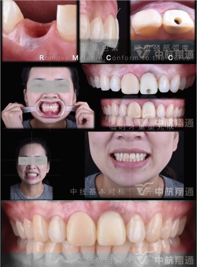 PSTD软组织增量之后的美学修复