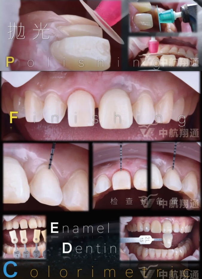 PSTD软组织增量之后的美学修复