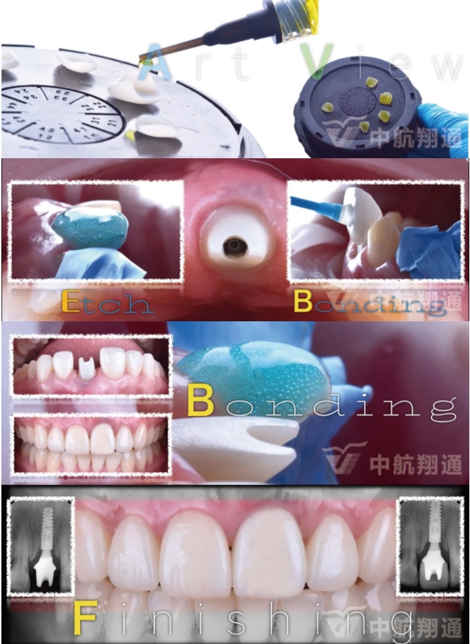 PSTD软组织增量之后的美学修复