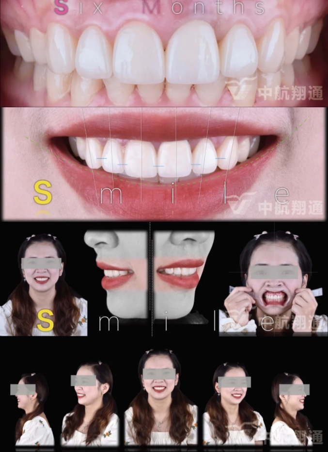 PSTD软组织增量之后的美学修复