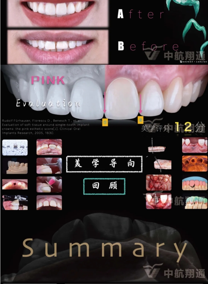 PSTD软组织增量之后的美学修复