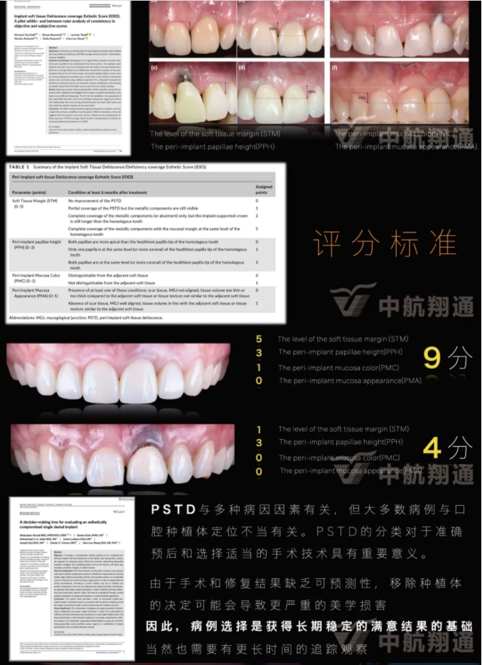 PSTD软组织增量之后的美学修复