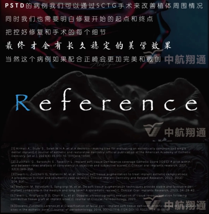PSTD软组织增量之后的美学修复
