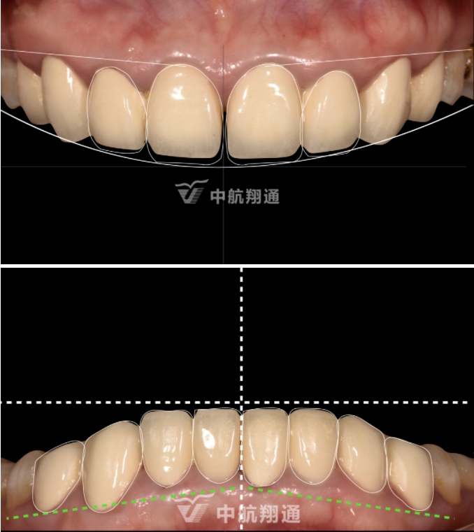 前牙全瓷美学修复临床病例分享