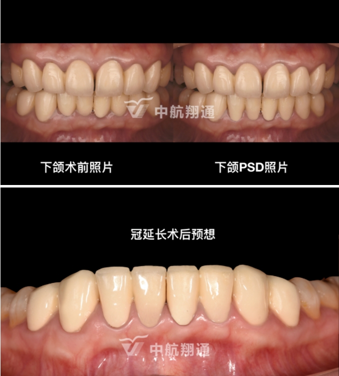 前牙全瓷美学修复临床病例分享