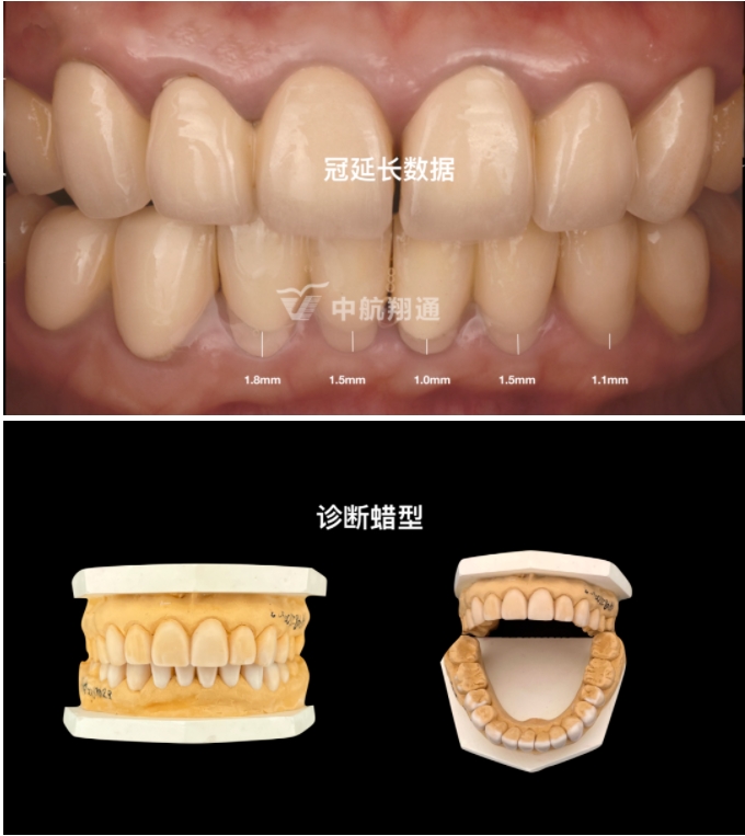 前牙全瓷美学修复临床病例分享