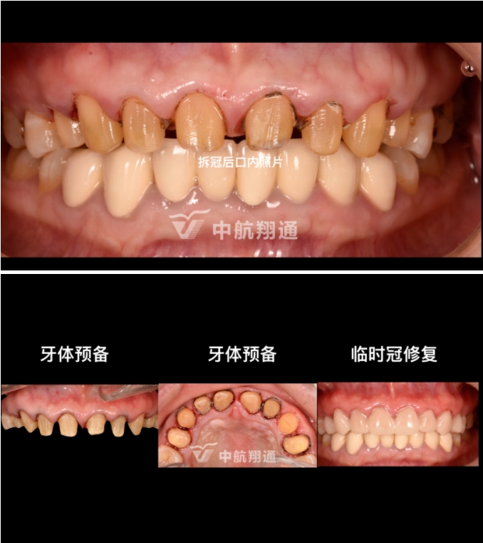 前牙全瓷美学修复临床病例分享