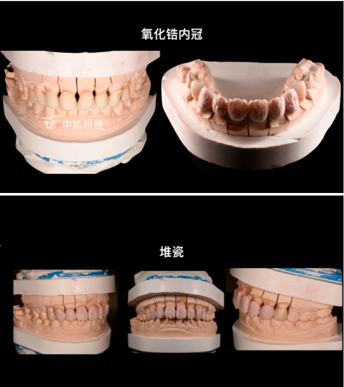 前牙全瓷美学修复临床病例分享