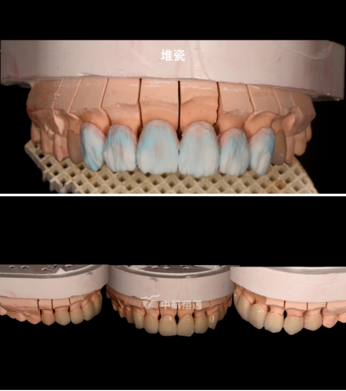 前牙全瓷美学修复临床病例分享