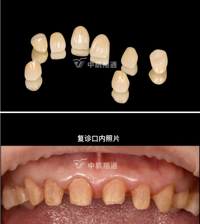 前牙全瓷美学修复临床病例分享