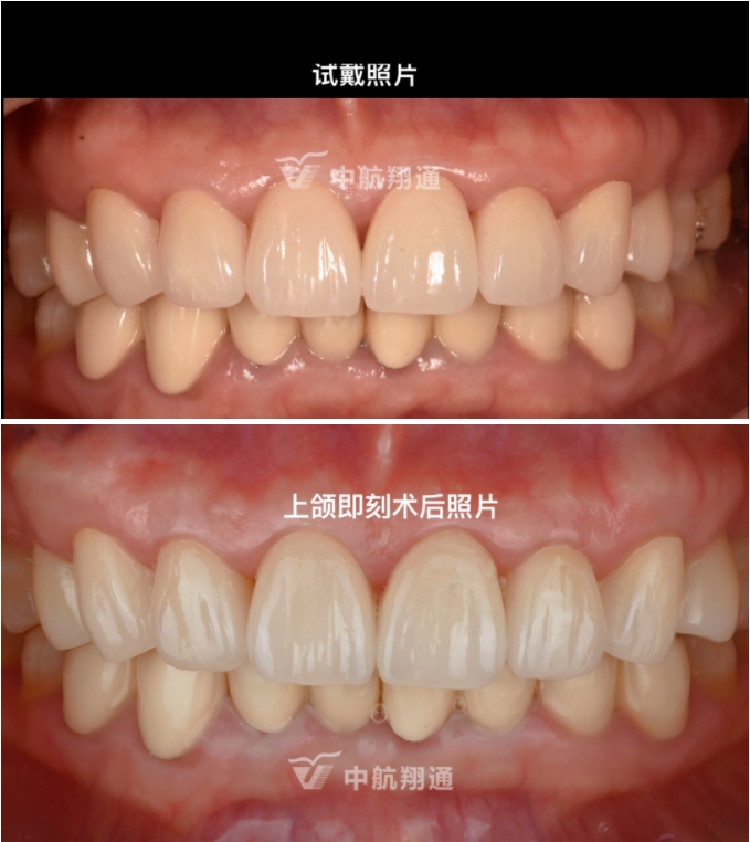 前牙全瓷美学修复临床病例分享