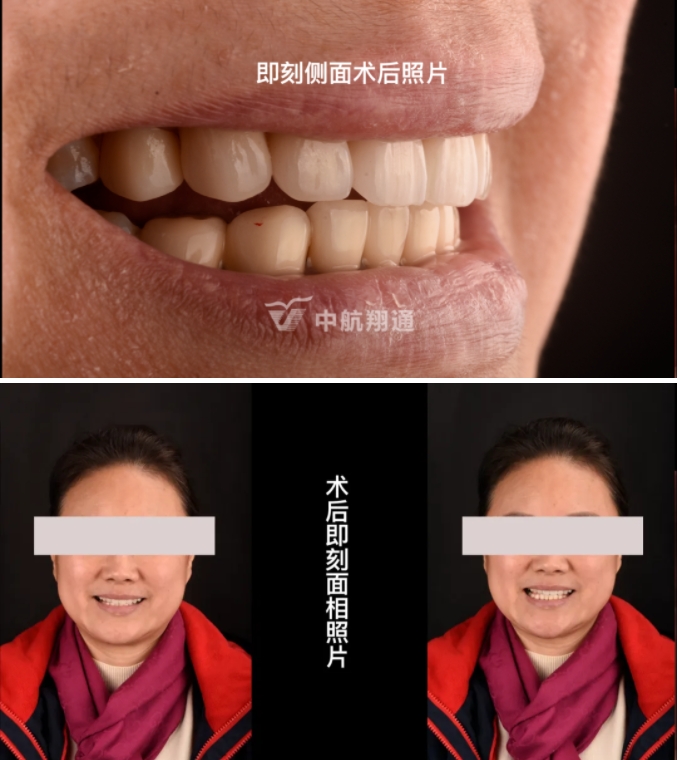 前牙全瓷美学修复临床病例分享