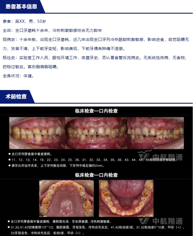 2024华人美学临床病例大赛获奖病例|以美学设计为导向的牙列重度磨耗患者全牙列咬合重建