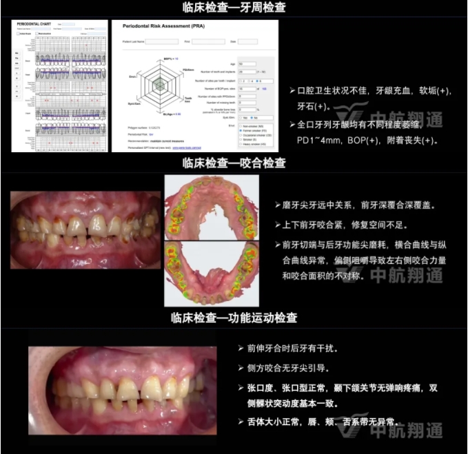 2024华人美学临床病例大赛获奖病例|以美学设计为导向的牙列重度磨耗患者全牙列咬合重建