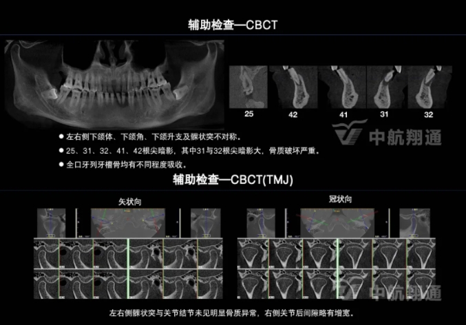 2024华人美学临床病例大赛获奖病例|以美学设计为导向的牙列重度磨耗患者全牙列咬合重建