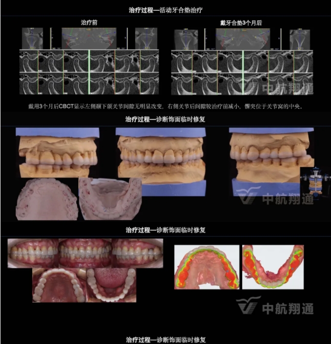2024华人美学临床病例大赛获奖病例|以美学设计为导向的牙列重度磨耗患者全牙列咬合重建