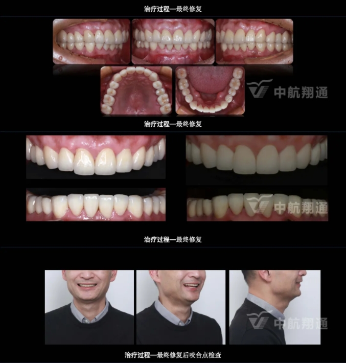 2024华人美学临床病例大赛获奖病例|以美学设计为导向的牙列重度磨耗患者全牙列咬合重建