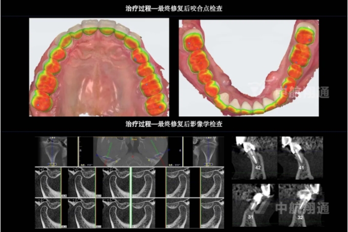 2024华人美学临床病例大赛获奖病例|以美学设计为导向的牙列重度磨耗患者全牙列咬合重建