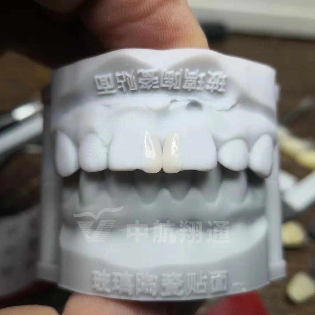 玻璃陶瓷前牙美学修复一例