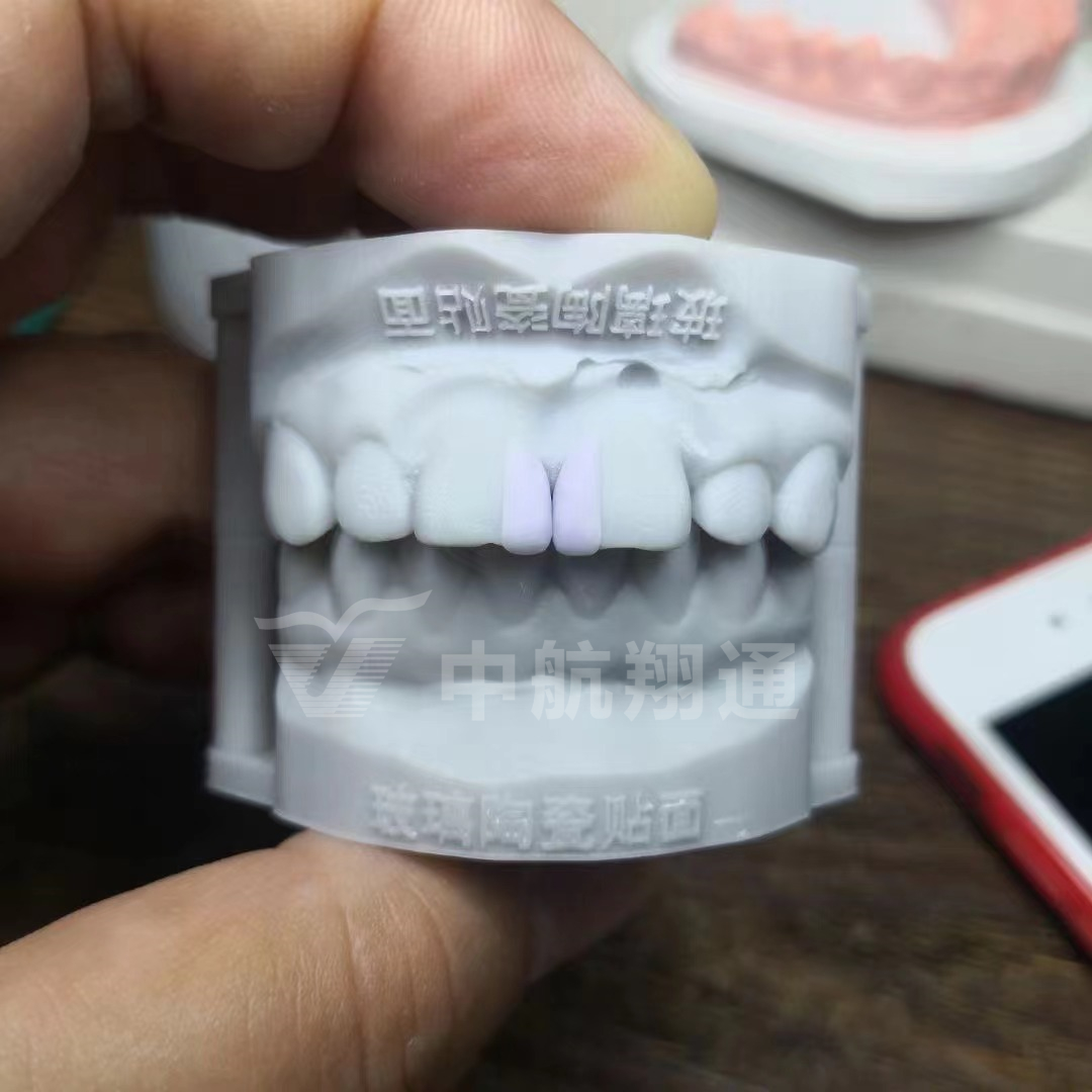 玻璃陶瓷前牙美学修复一例